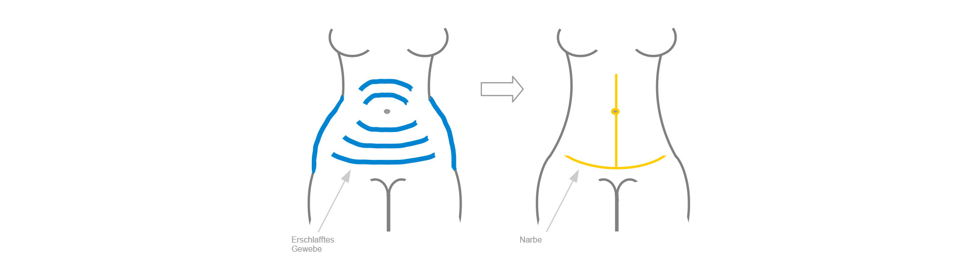Fleur-de-lis Abdominoplastik Schematische Darstellung der Bauchdeckenstrafung bei der Fleur-de-lis / T-Schnitt / Ankerschnitt Methode