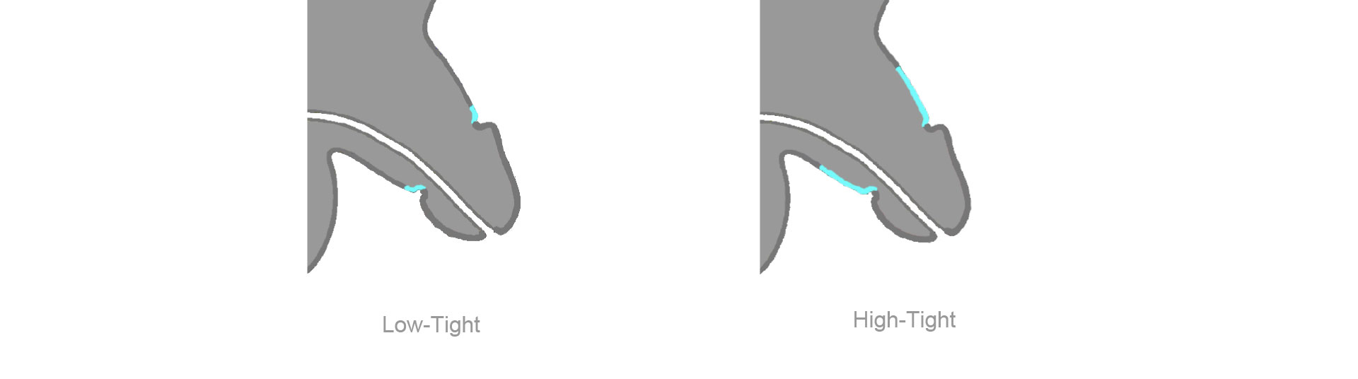 Schematische Darstellung der Low-Tight- und High-Tight- Beschneidung