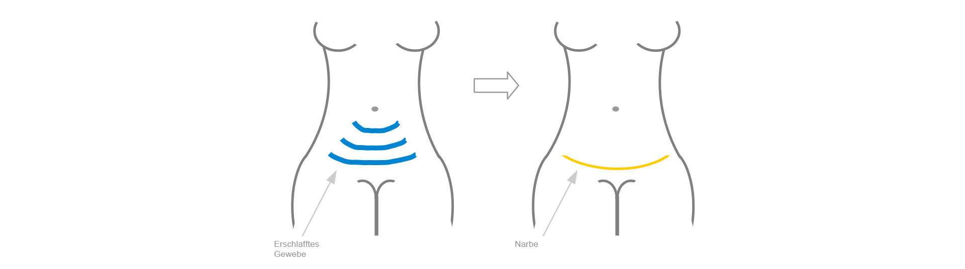 Mini-Abdominoplastik Schematische Darstellung der kleinen Bauchdeckenstrafung