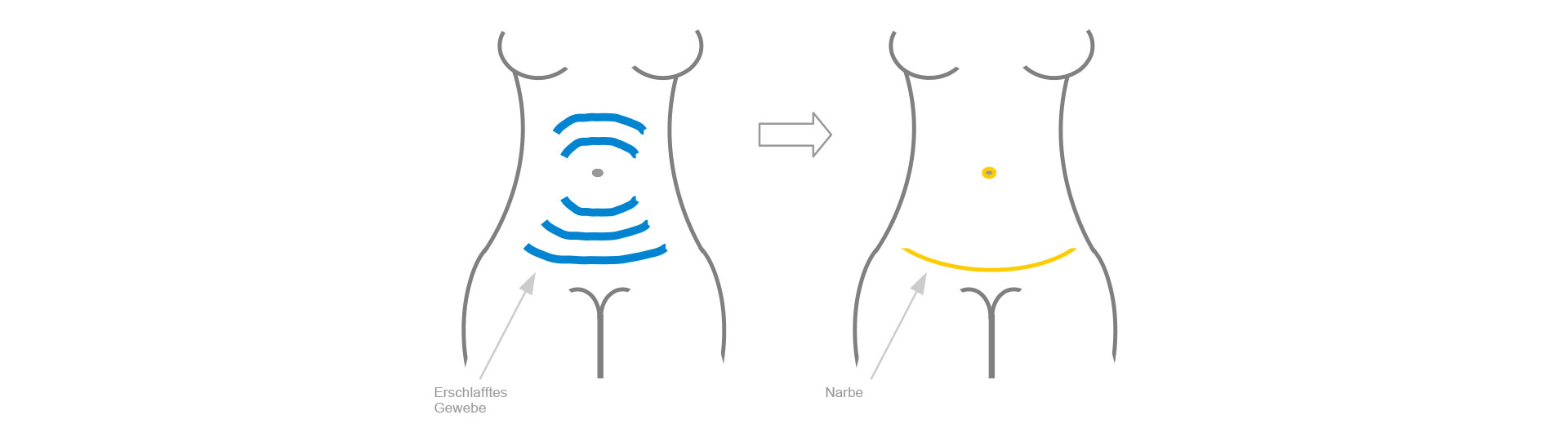 Klassische Abdominoplastik Schematische Darstellung der klassischen Bauchdeckenstrafung