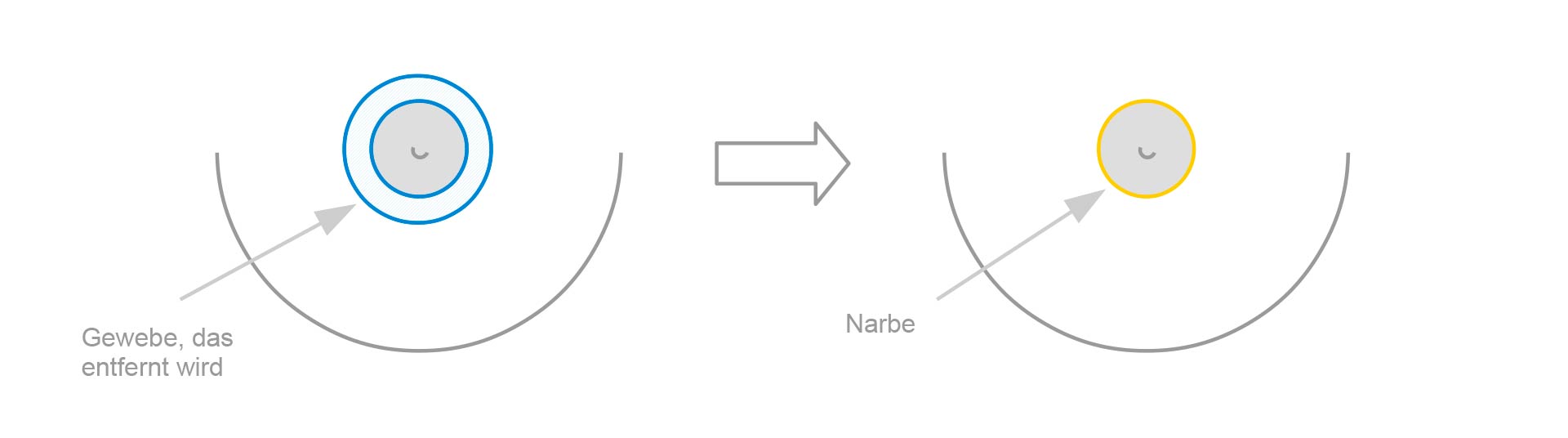 Schematische Darstellung einer o-Straffung der Brust