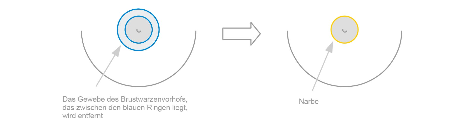 Schematische Darstellung der Verkleinerung des Brustwarzenvorhofs