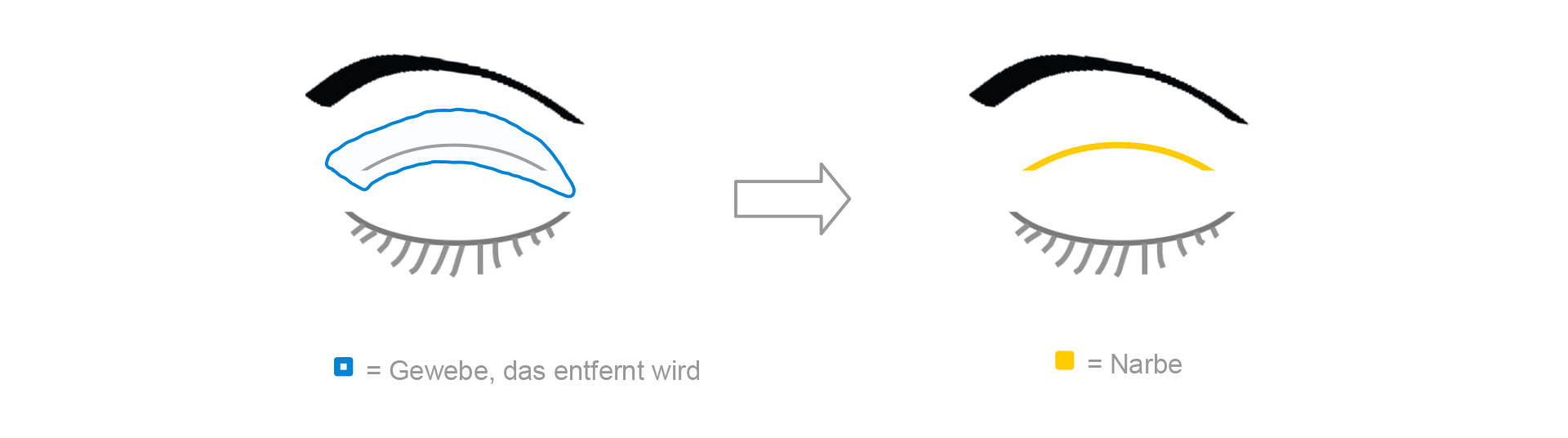 Schematische Darstellung der Oberlidstraffung