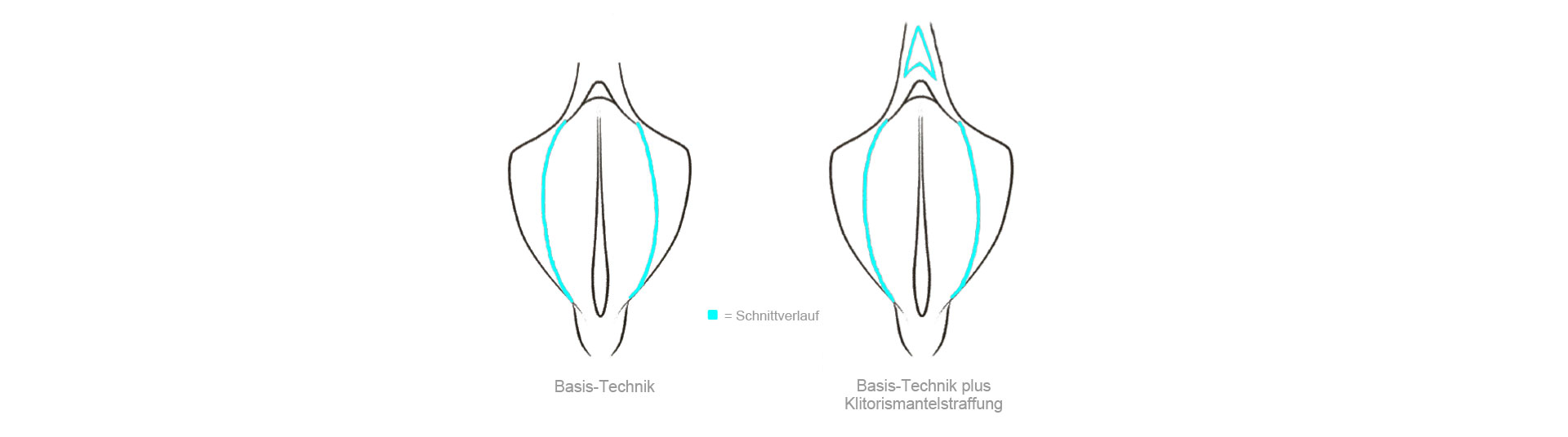 Schematische Darstellung der Schamlippenverkleinerung in Basis-Technik und plus Klitorismantelstraffung