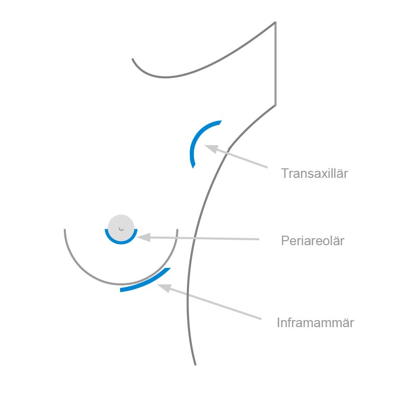Schnittführungen Schematische Darstellung der verschiedenen Schnittführungen bei der Brustvergrößerung mit Implantaten