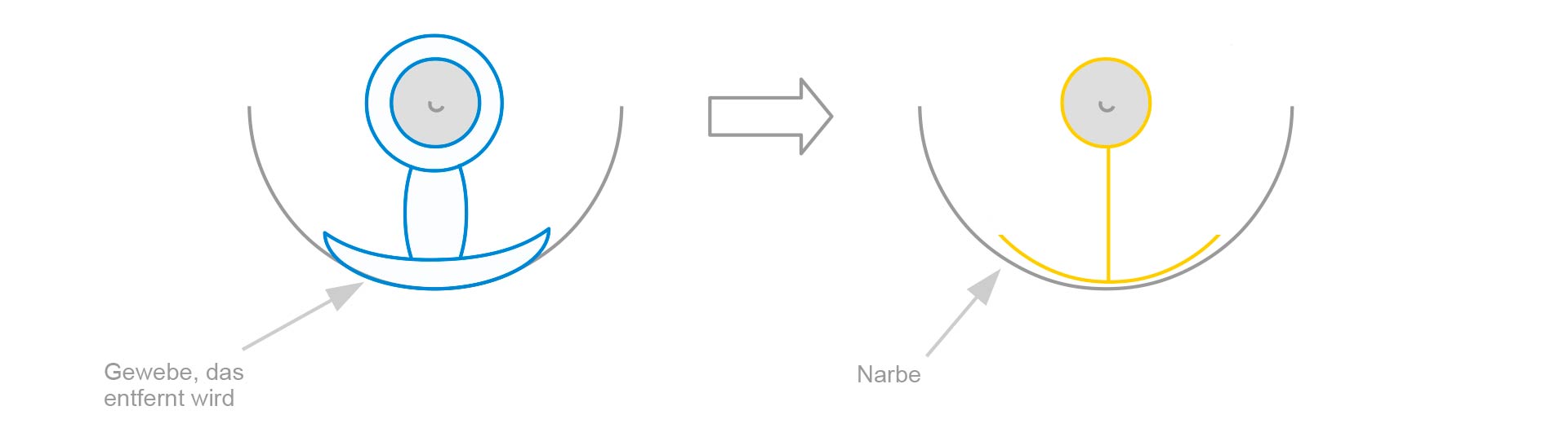 Schematische Darstellung einer T-Straffung der Brust