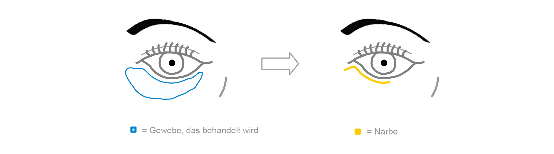 Unterlidstraffung Schematische Darstellung der Unterlidstraffung
