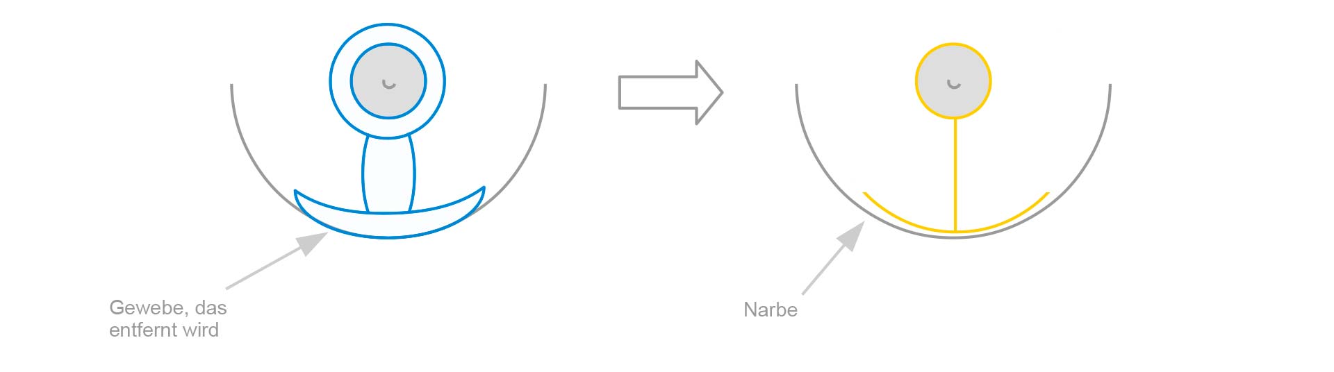 T-Schnitt-Technik Schematische Darstellung einer Brustverkleinerung in T- Schnitt-Technik