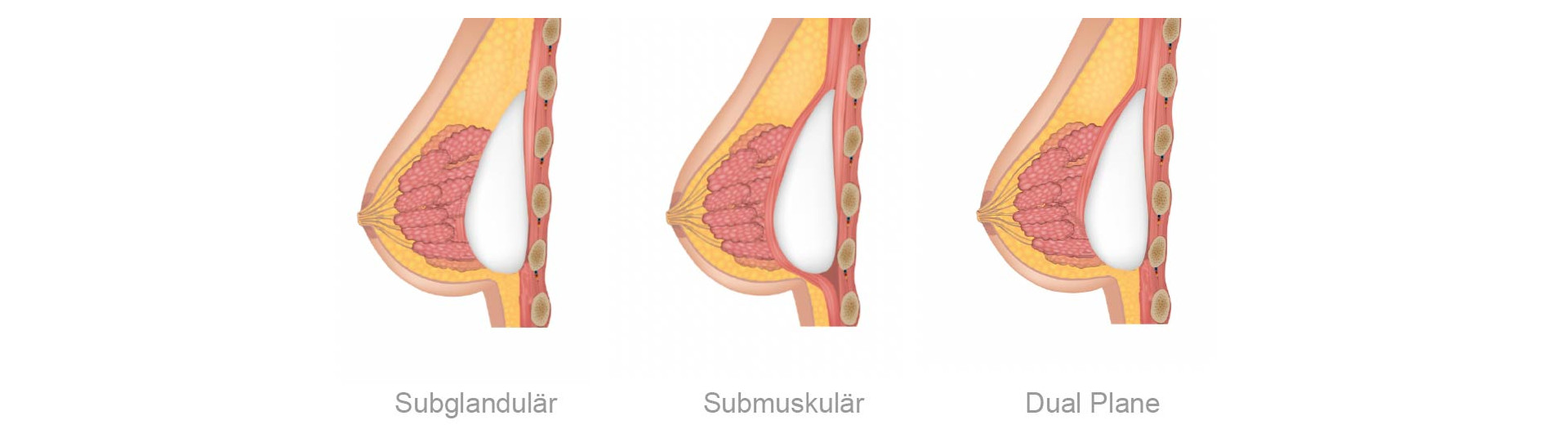 Implantatposition Schematische Darstellung der verschiedenen Positionen des Implantates bei der Brustvergrößerung mit Implantaten